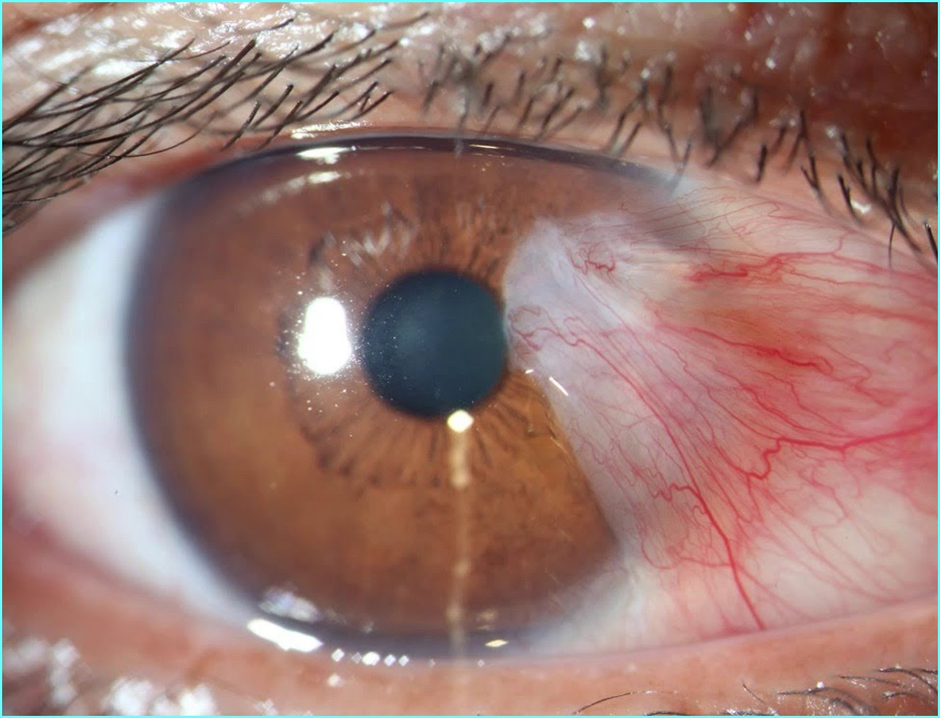 Olho com pterígio - tecido fibrovascular sobre a córnea